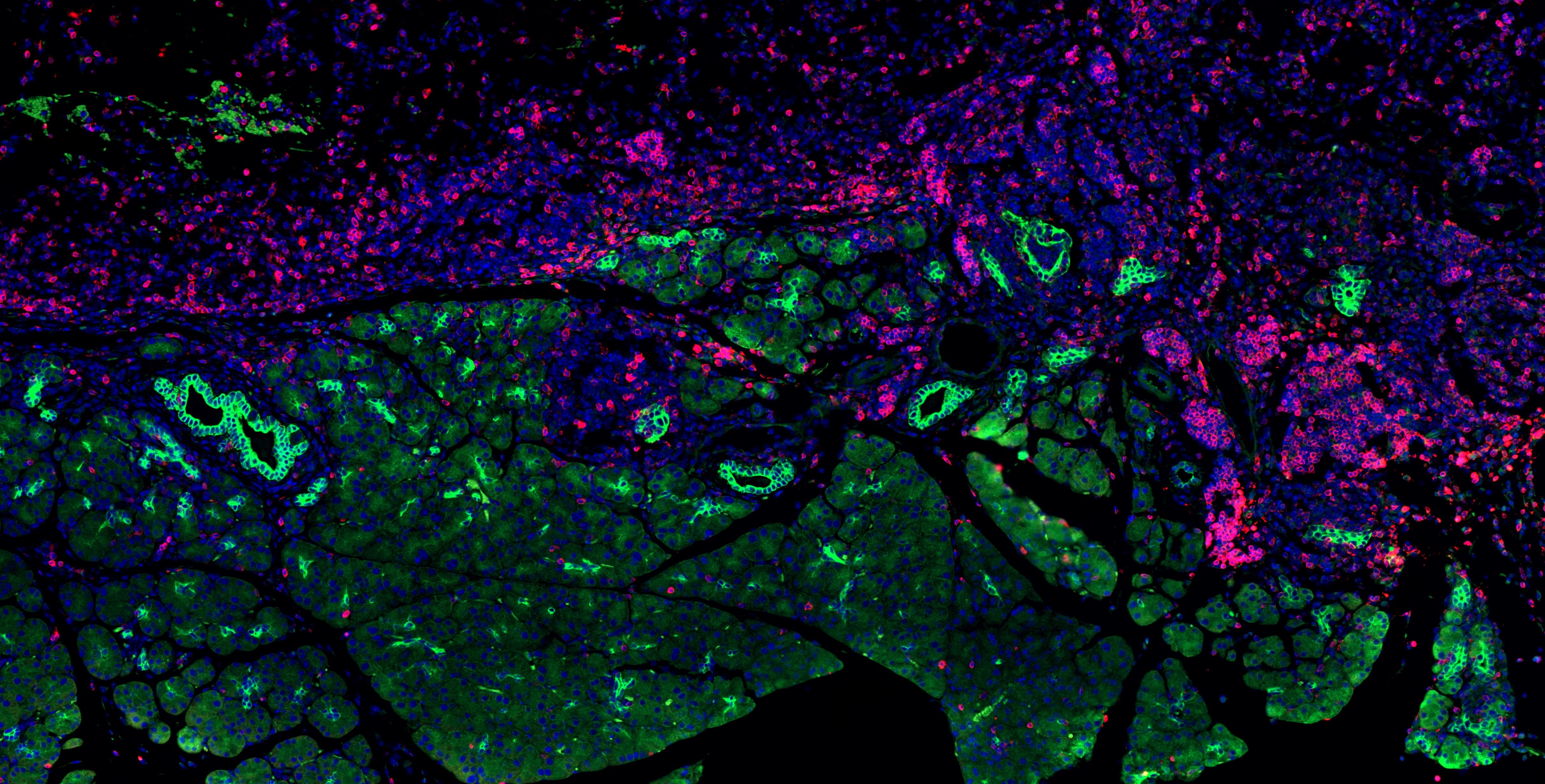 pancreatic cancer pancreatic cancer