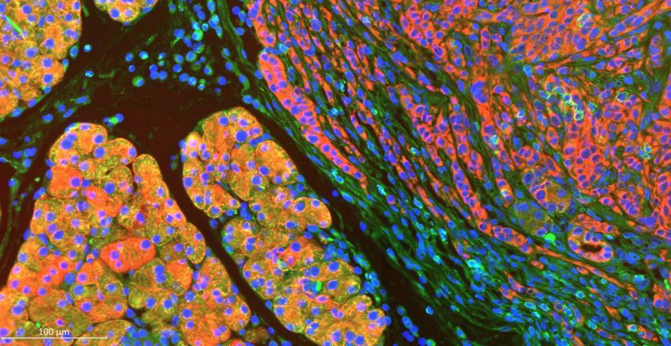 Immunofluorescence Imaging of Mouse Pancreatic Tumor