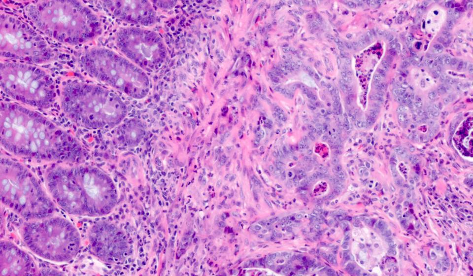 H&E Staining of Mouse Colon Tumor 