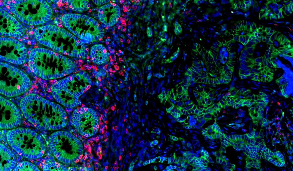 Immunofluorescence of Mouse Colon Tumor (CD3+ cells in red)
